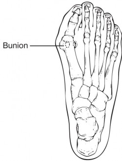 Bunion Diagram