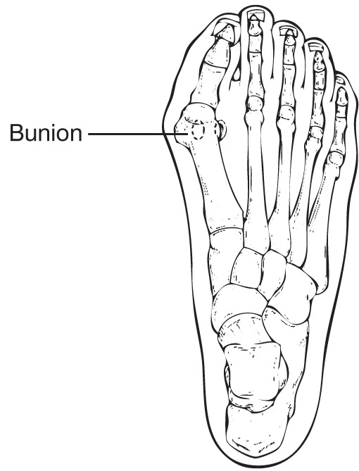 Bunion Diagram