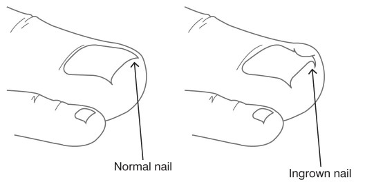 Ingrown Toenail