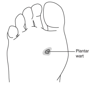 Plantar Wart