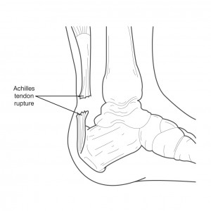 Achilles tendon rupture