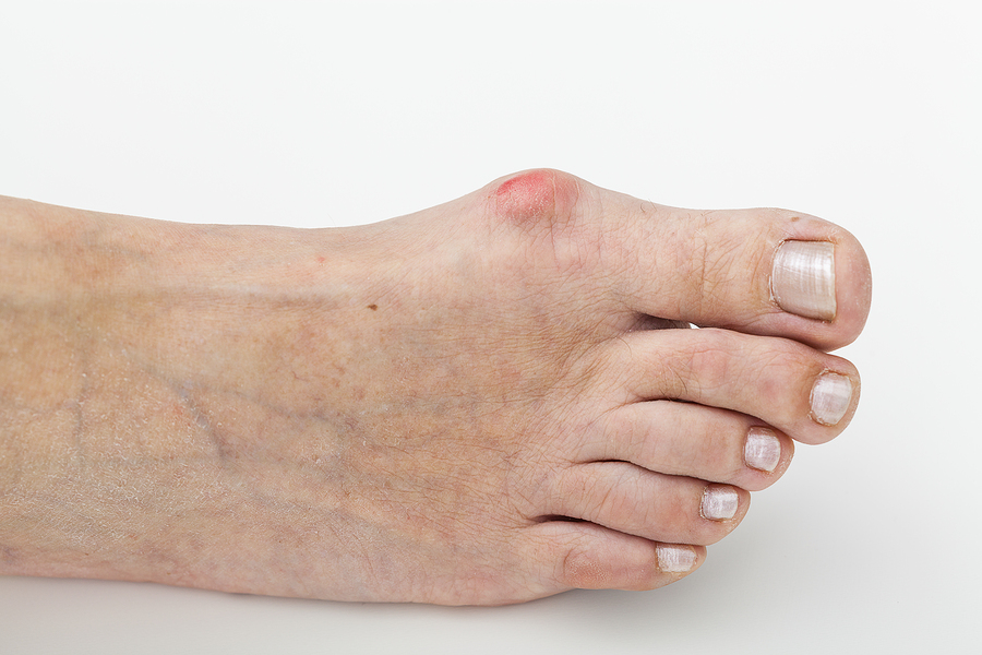 When Should I Consider Bunion Surgery Greater Houston Foot Ankle when-should-i-consider-bunion-surgery-greater-houston-foot-ankle